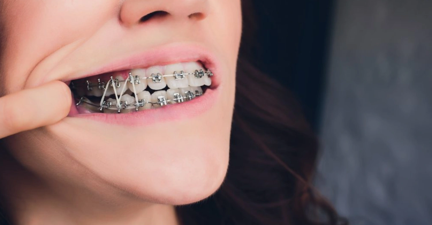 Metal Braces Inblog